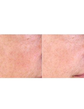 Masajeador facial Perfectio