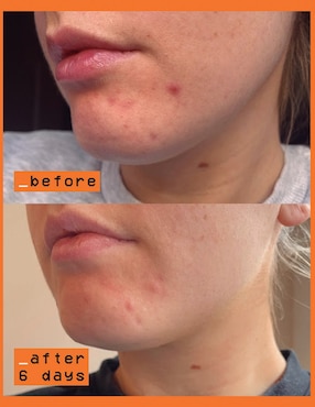 Sérum antimanchas Glow Hub The Vitamin C Scar Slayers todo tipo piel