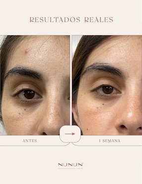 Sérum antiacné facial Oil Control Nunun Skin de piel mixta y grasa