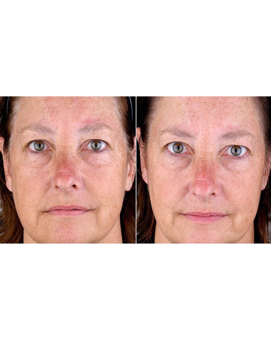 Masajeador facial 6