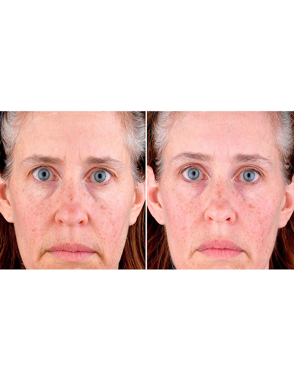 Masajeador facial 7