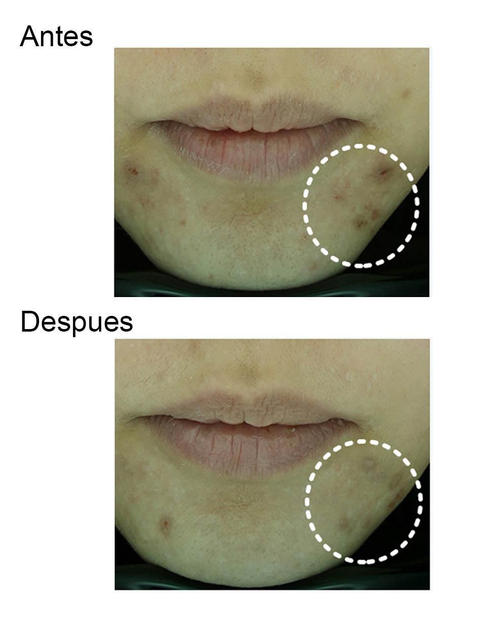 Crema facial recomendada para acné día y noche Acné Y Poros para piel seca y sensible 4