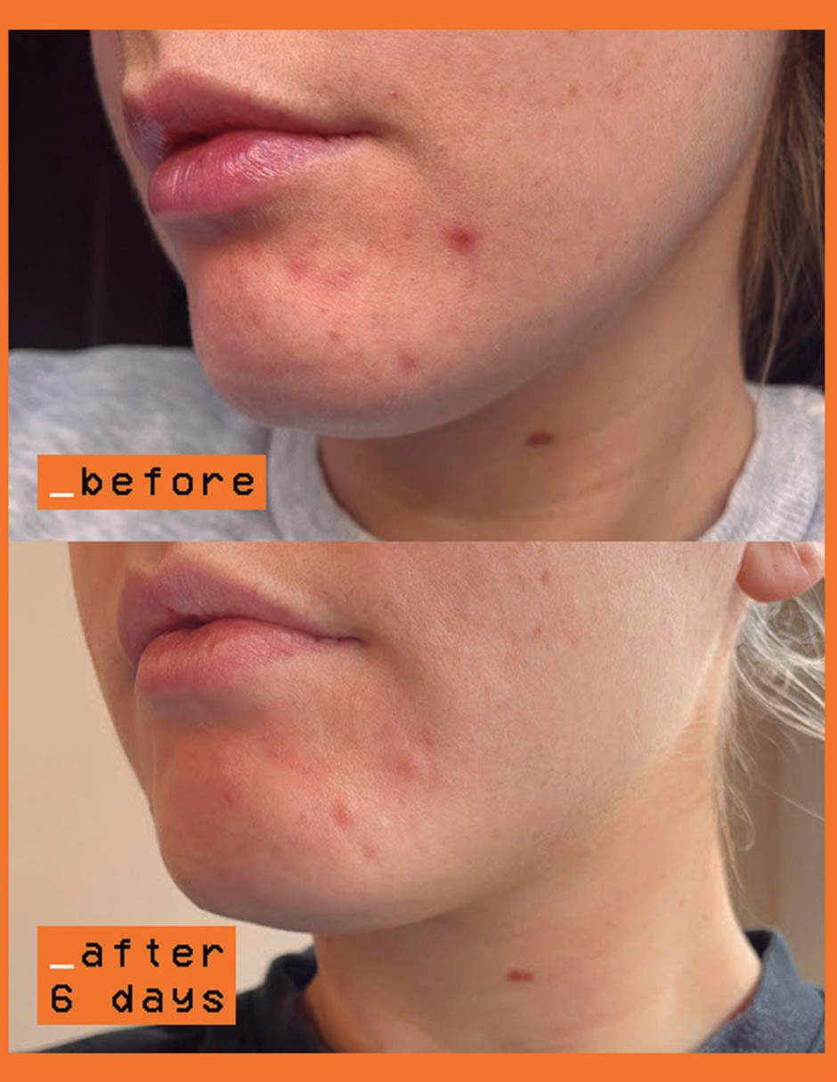 Sérum antimanchas The Vitamin C Scar Slayers todo tipo piel 4