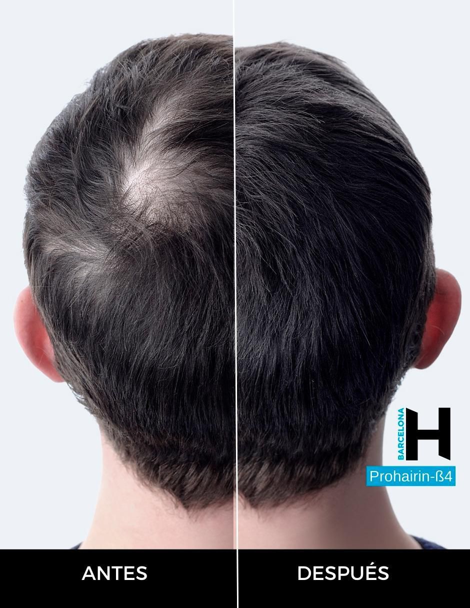 Set tratamiento capilar dúo prevención caída shampoo + loción anti caída con prohairin B4 3